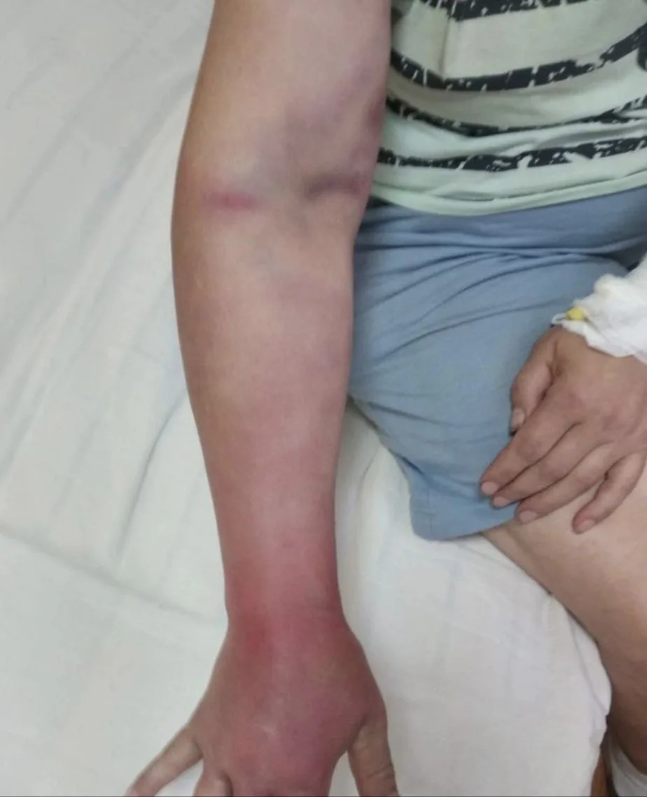 В Самарской области женщина спутала шланг с ядовитой гадюкой и чуть не потеряла жизнь