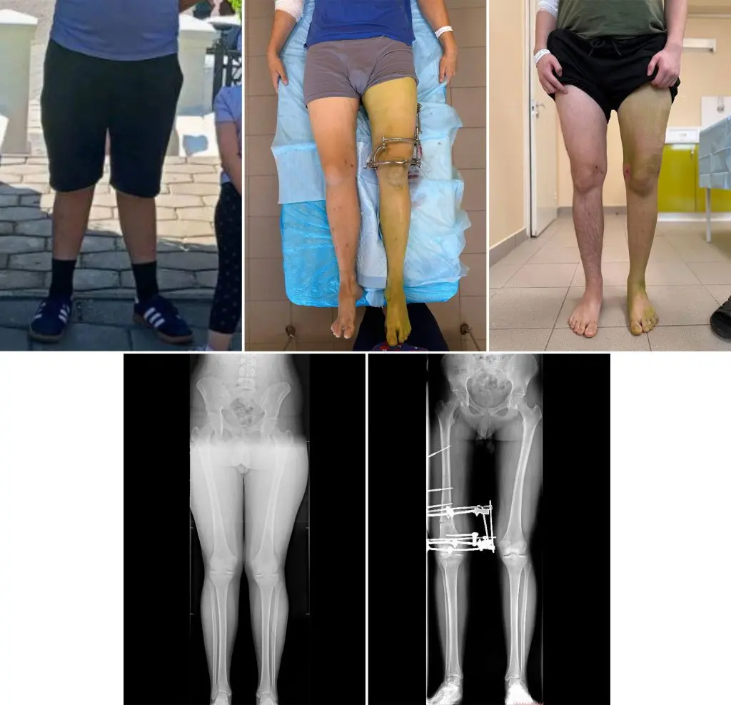 Врачи из Самары устранили у подростка Х-образное искривление ног